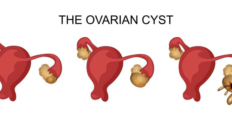 ovarian